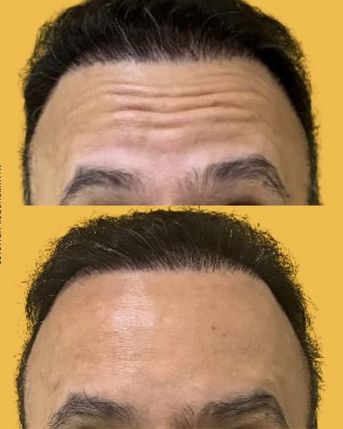 Botox masculino: o que muda no rosto do homem?